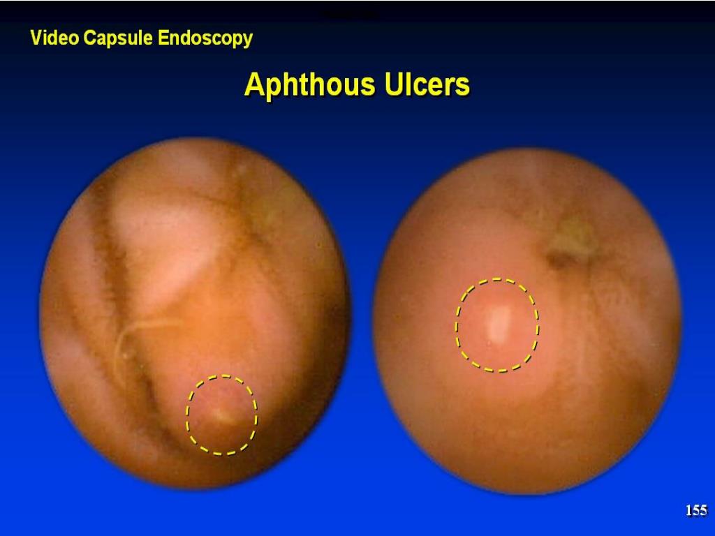 Aphthous ulcers in terminal ileum