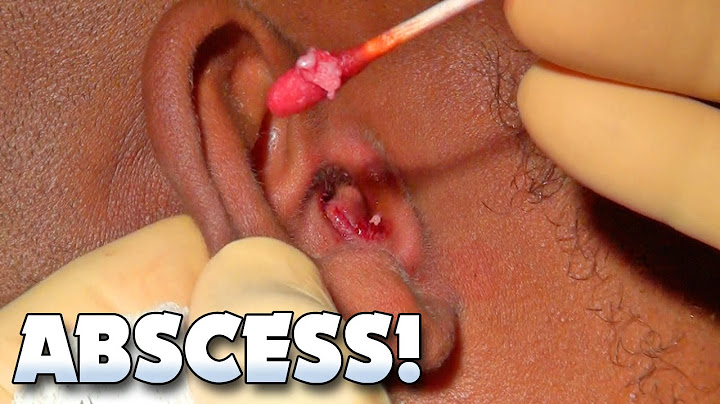 Zit popping in ear