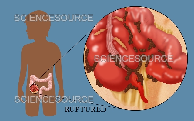 Is ruptured appendix hereditary