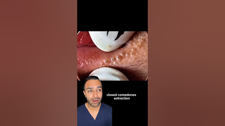 Blackheads above lips