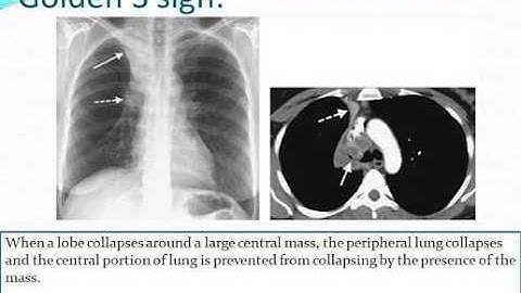 Ss or ct meaning