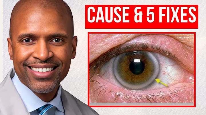 Can corneal arcus be reversed