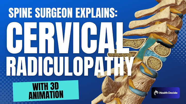 Radiculopathy cervical region m54 12
