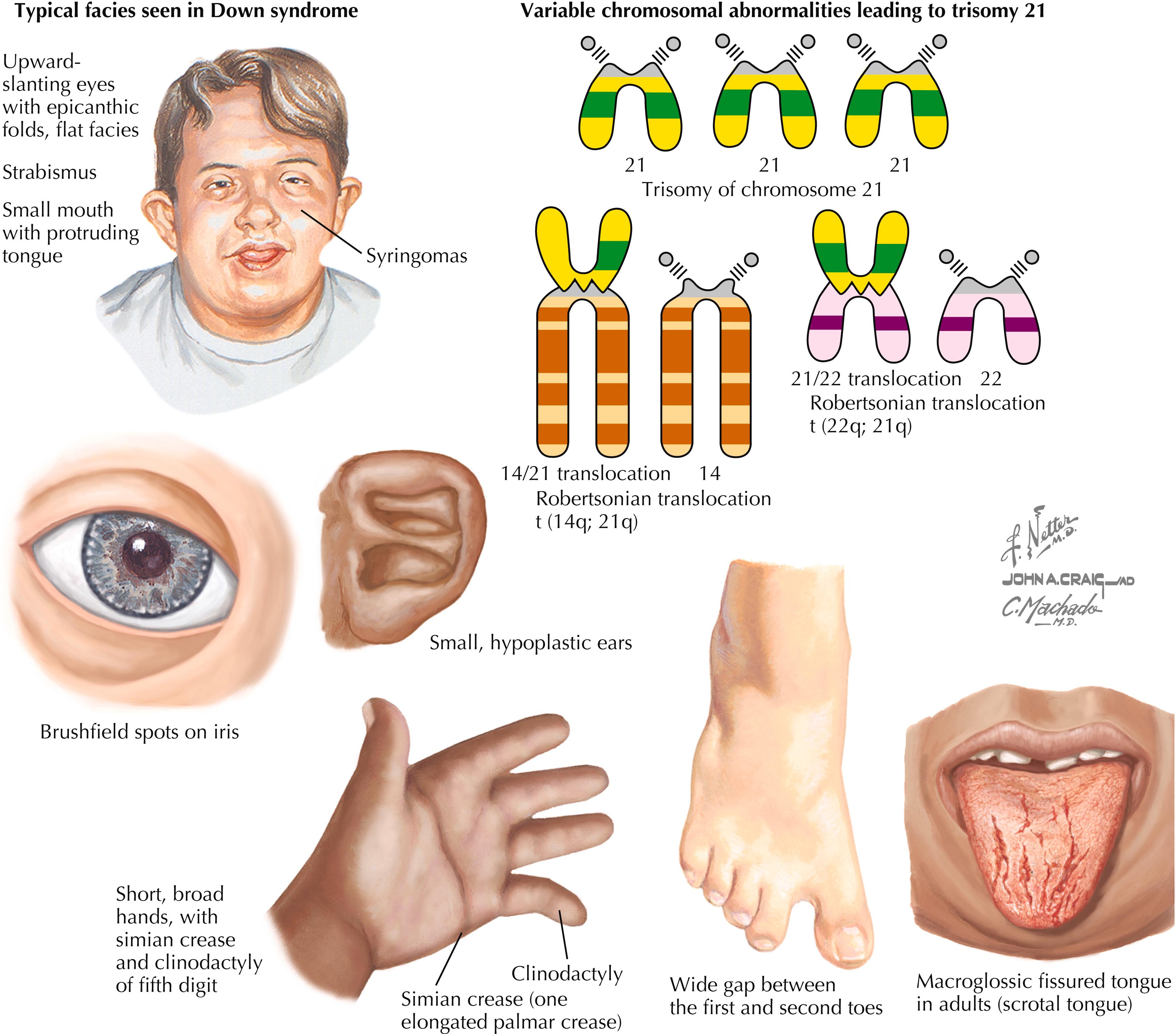 Can someone have features of down syndrome without having it