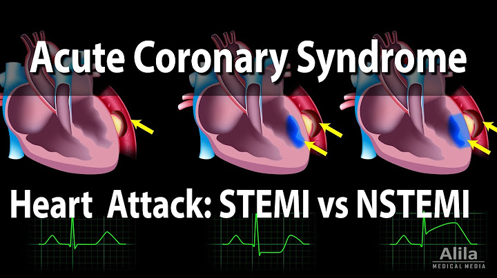 N-stemi